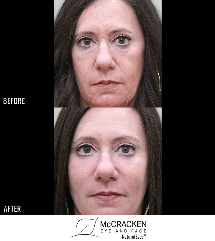 51 Year Old Female – Mid-Facelift with lower blepharoplasty, Periocular Laser Skin Resufacing, and Temporal Brow Lift. The Mid-Facelift was performed through incisions in the mouth and temples, without any skin incisions.