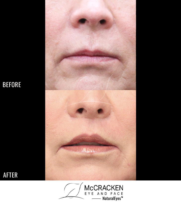 60 Year Old Female – Lip Lift to Enhance the Upper Lip. No Filler Added.