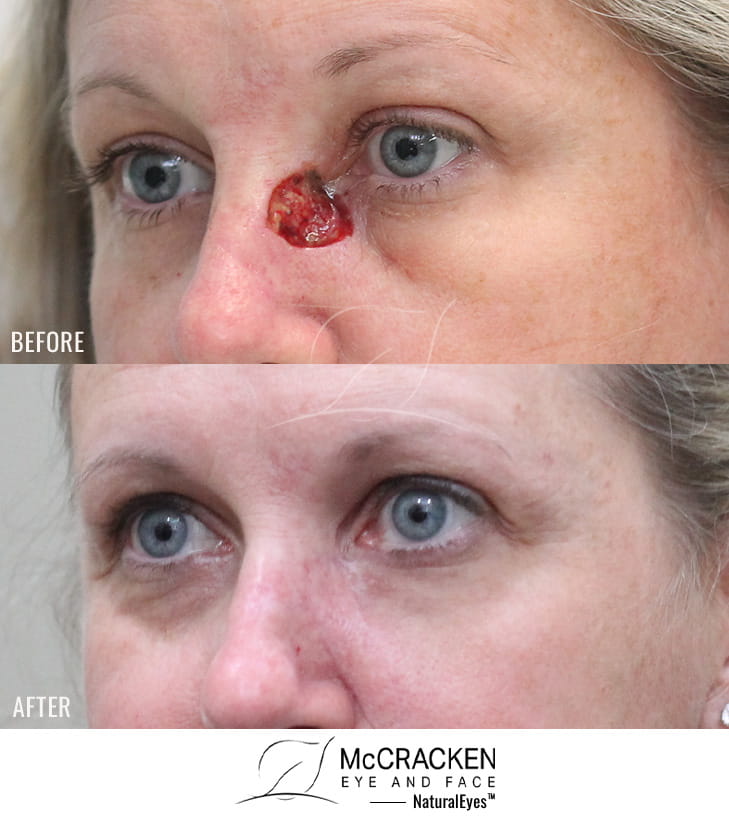 50 Year Old Female – Repair of Defect After Excision of Squamous Cell Carcinoma