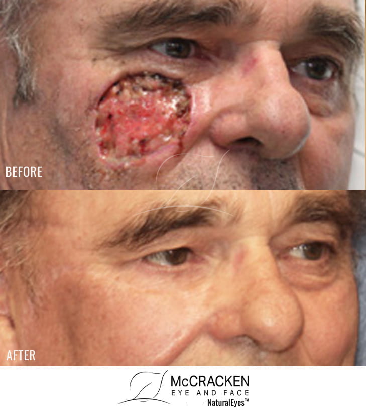 68 year old male – Repair of Left Upper Lid Defect after excision of melanoma in situ.