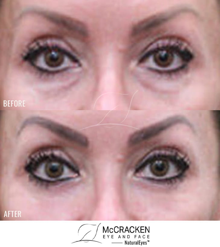 40 Year Old Female – Lower Blepharoplasty and Periocular Laser Skin Resurfacing.