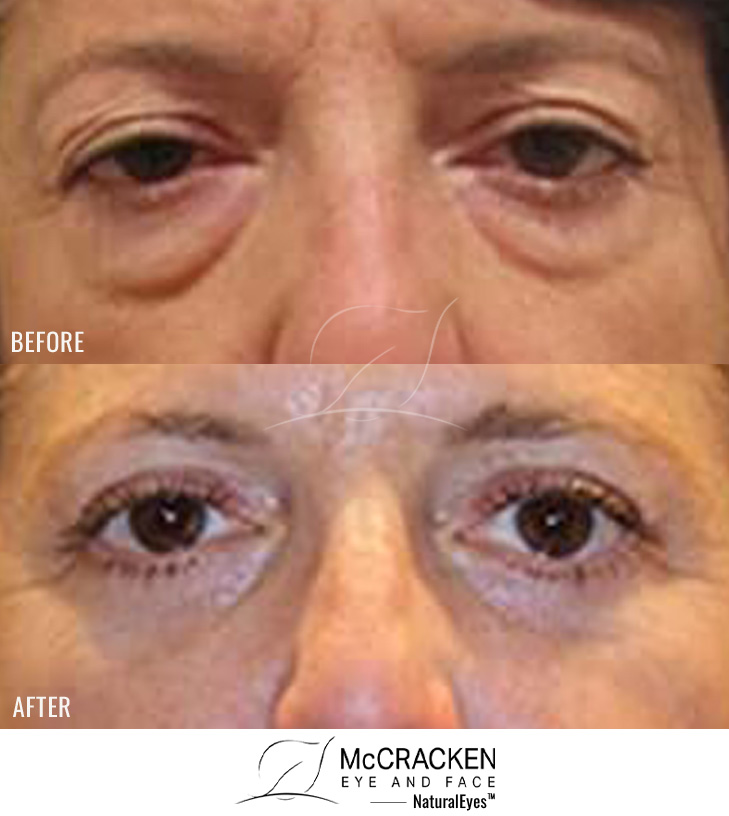 53 Year Old Female Upper and Lower Blepharoplasty
