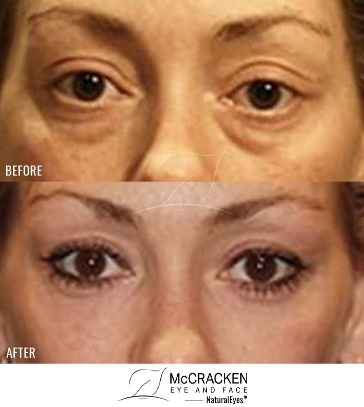 41 Year Old Female – Lower Blepharoplasty with Periocular Laser Skin Resurfacing