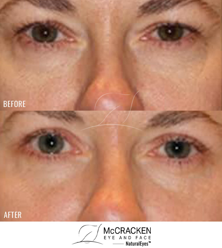 45 Year Old Female – Upper and Lower Blepharoplasty
