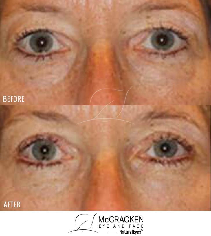 53 Year Old Female – Upper and Lower Blepharoplasty