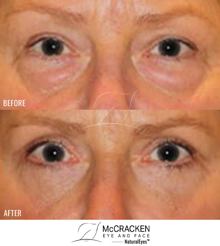 56 Year Old Female – Upper and Lower Blepharoplasty