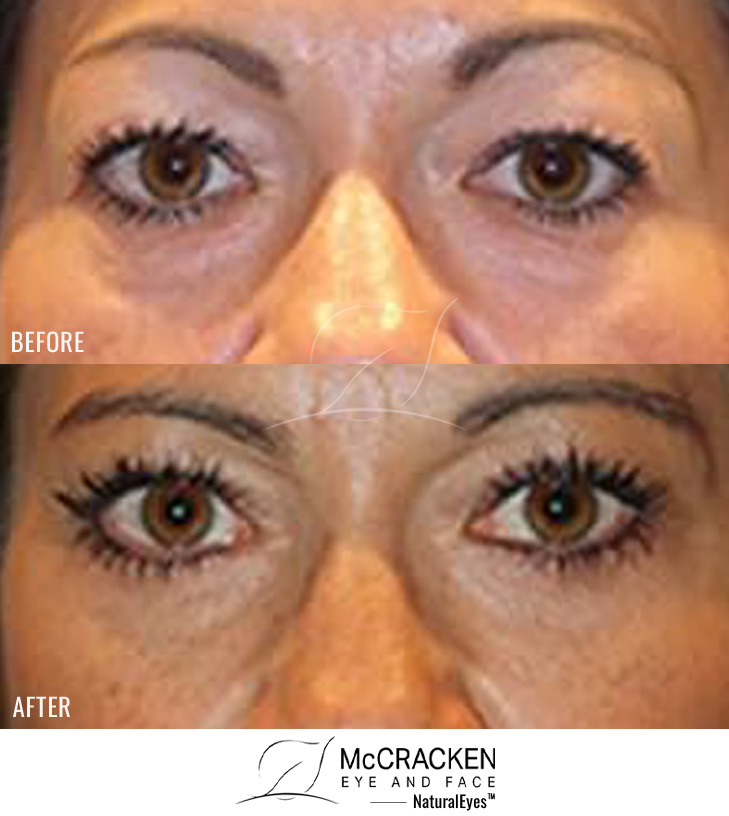 47 Year Old Female – Upper and Lower Blepharoplasty