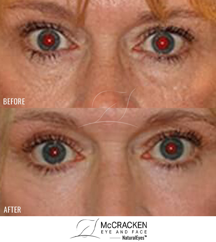 54 year old female – Bilateral Lower Blepharoplasty with Periocular Laser Skin Resurfacing
