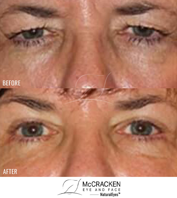 52 Year Old Female – Upper and Lower Blepharoplasty