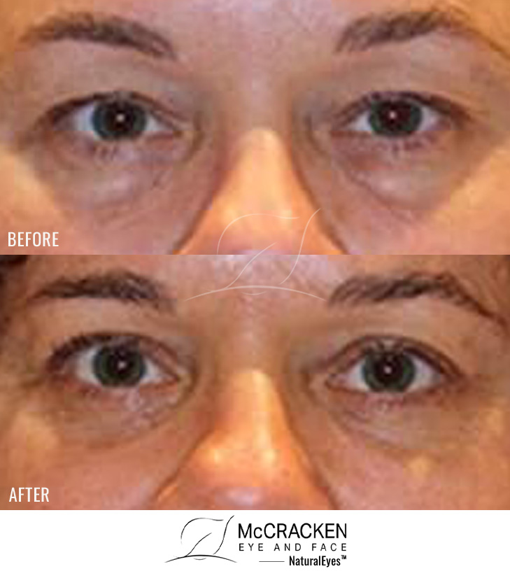 51 Year Old Female – Upper and Lower Blepharoplasty Periocular Laser Skin Resurfacing