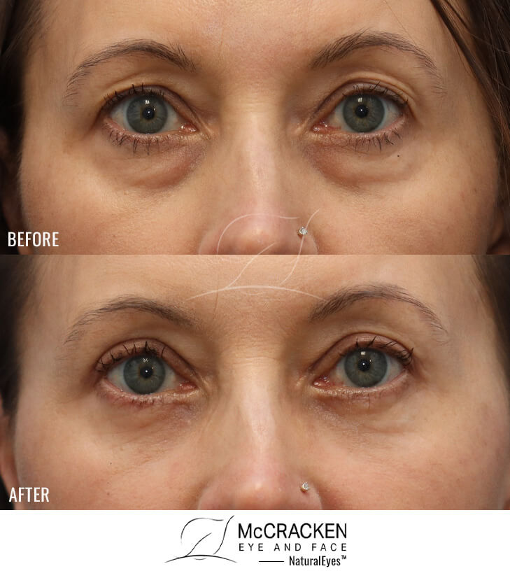 54 Year Old Female Upper and Lower Blepharoplasty with AccuTite Radiofrequency to Lower Lid Skin. A Lower Lid Skin Pinch Excision Was Performed.