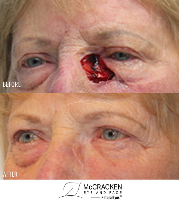 78 year old female – Repair of left lower lid, medial canthal, and nose Mohs defect after excision of basal cell carcinoma.