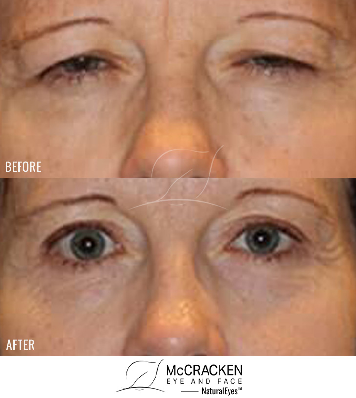 53 Year Old Female – Brow Lift, Upper Blepharoplasty Full Face Laser Skin Resurfacing