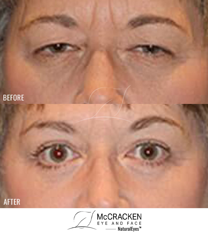 52 Year Old Female – Upper and Lower Blepharoplasty