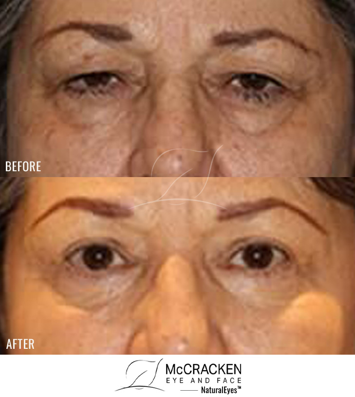 68 Year Old Female – Upper and Lower Blepharoplasty with Periocular Laser Skin Resurfacing