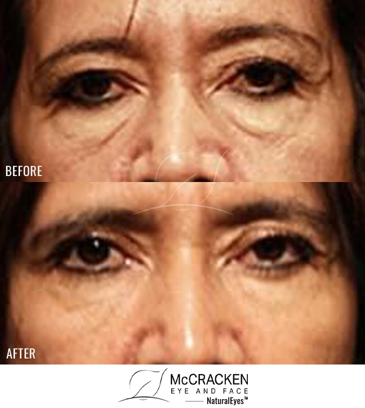 58 Year Old Female – Upper and Lower Blepharoplasty