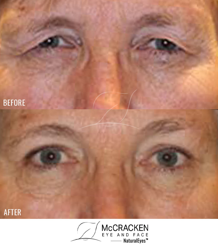 61 Year Old Female Upper – Blepharoplasty and Brow Lift