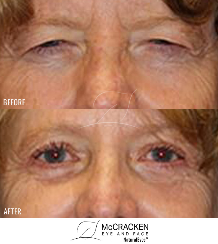 59 Year Old Female – Upper and Lower Blepharoplasty and Brow Lift