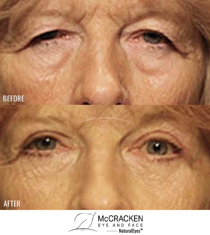 73 Year Old Female – Upper and Lower Blepharoplasty