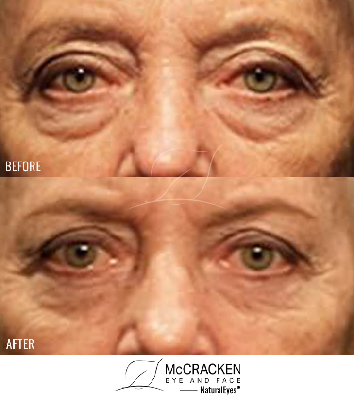 65 Year Old Female – Upper and Lower Blepharoplasty