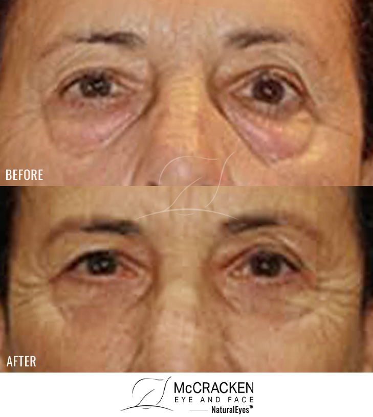 68 Year Old Female – Right Upper Lid Ptosis Repair and Bilateral Lower Blepharoplasty