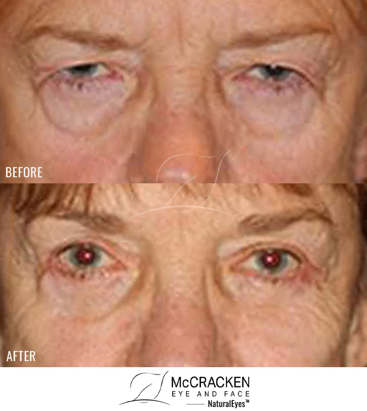 71 Year Old Female Female – Upper and Lower Blepharoplasty