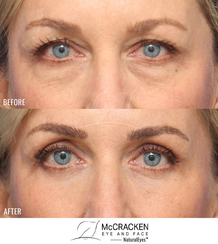 54 Year Old Female Upper and Lower Blepharoplasty with AccuTite Radiofrequency to Lower Lid Skin. A Lower Lid Skin Pinch Excision Was Performed.