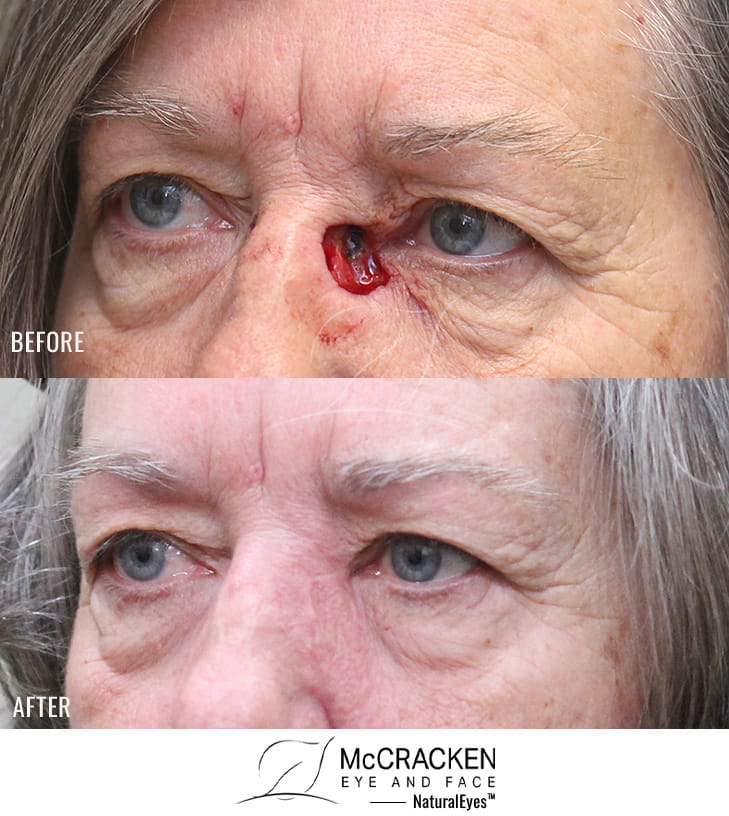 72 Year Old Female – Repair of Mohs Defect after Excision of Basal Cell Carcinoma.