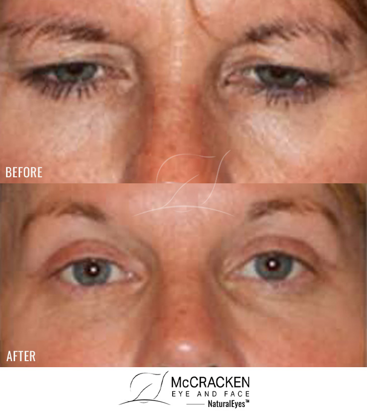 48 Year Old Female – Upper Blepharoplasty