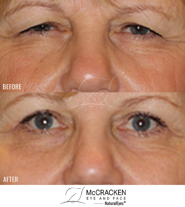 62 Year Old Female – Full Face Fractional CO2 Laser Skin Resurfacing, Bilateral Upper Lid Blepharoplasty