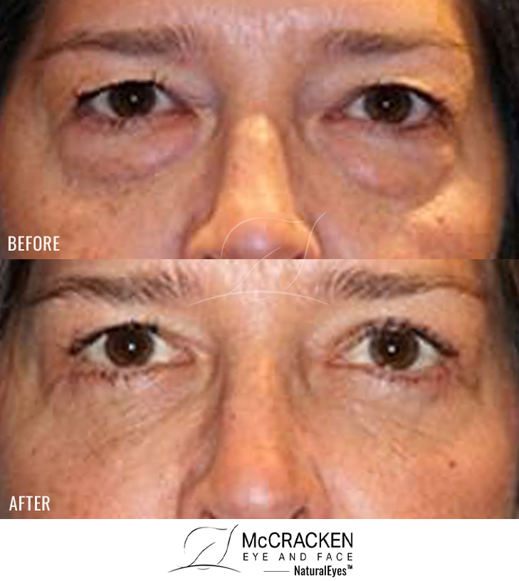53 Year Old Female – Lower Blepharoplasty