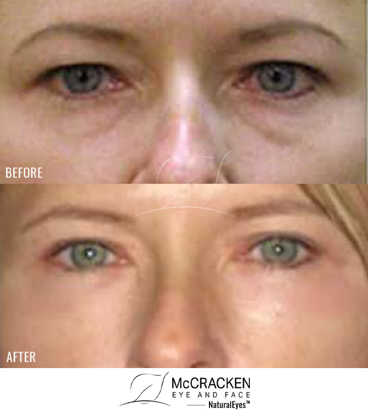 36 Year Old Female – Upper Blepharoplasty (Upper Eyelid Surgery), Lower Eyelid Laser Resurfacing, and Lower Eyelid Restylane®