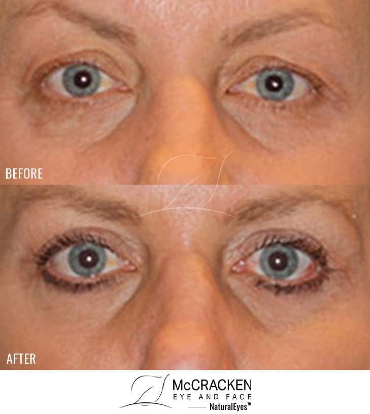 62 year old female – Bilateral upper and lower lid fractional CO2 laser skin resurfacing, Bilateral upper lid blepharoplasty