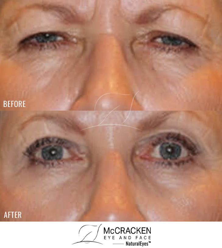 67 year old female – Full face fractional CO2 laser skin resurfacing, Bilateral endoscopic brow lift, Bilateral upper and lower lid blepharoplasty