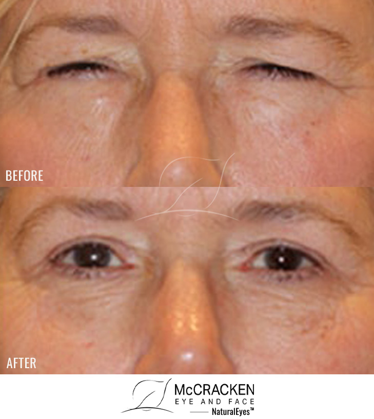 67 year old female – Full face fractional CO2 laser skin resurfacing, Bilateral upper and lower lid blepharoplasty