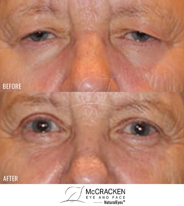 71 year old female – Full face fractional CO2 laser skin resurfacing, Bilateral upper lid blepharoplasty, Left brow lift