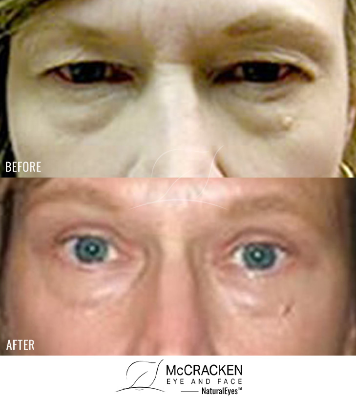 56 Year Old Female – Upper Blepharoplasty