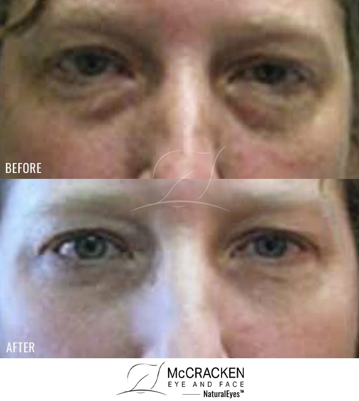 41 Year Old Female – Lower Blepharoplasty