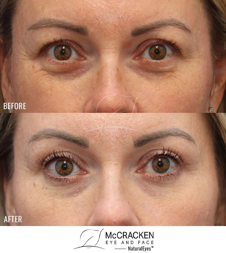51 Year Old Female Upper and Lower Blepharoplasty with Periocular Laser Skin Resurfacing. No lower lid skin incisions were made.
