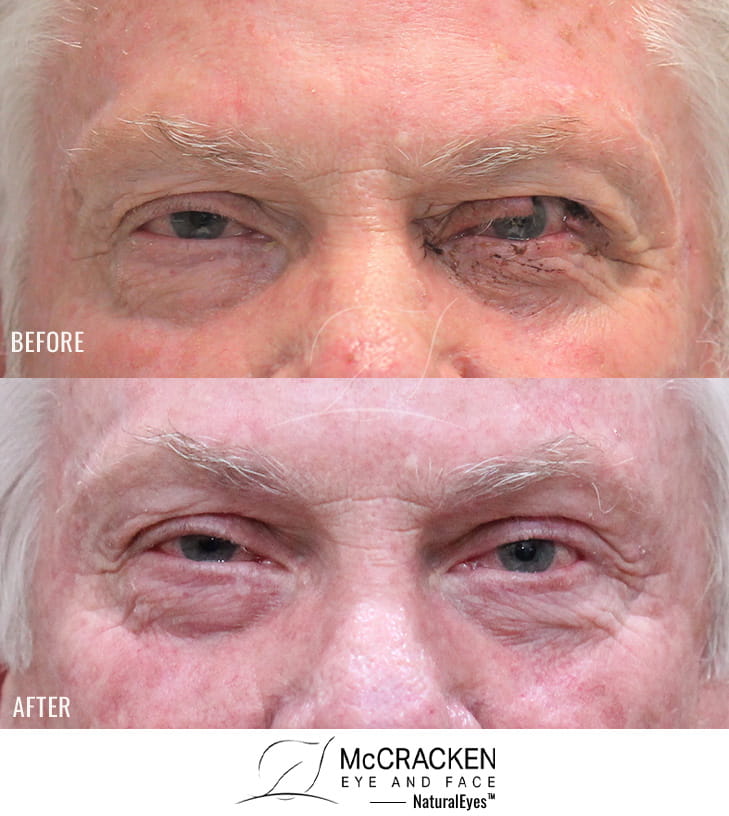 60 year old male – Repair of Left Upper Lid Defect after excision of basal cell carcinoma.