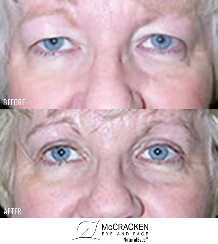 55 Year Old Female – Upper Blepharoplasty