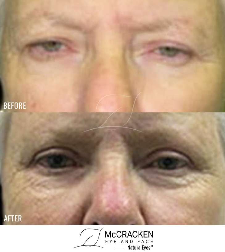 61 Year Old Female – Upper Blepharoplasty