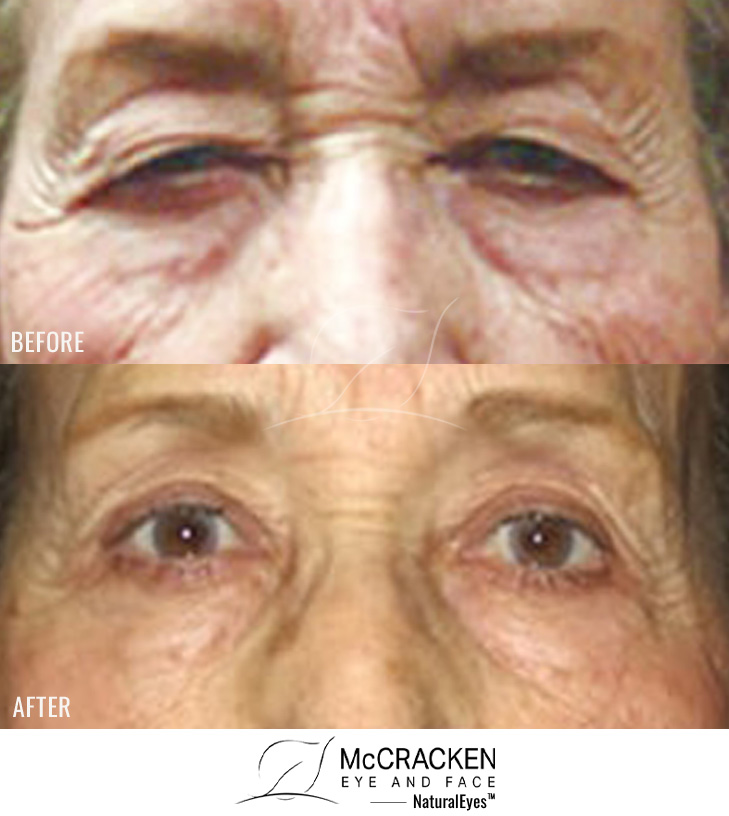83 Year Old Female – Upper Blepharoplasty