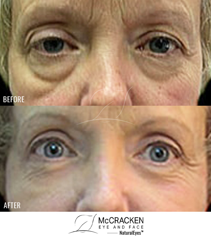 58 Year Old Female – Upper and Lower Blepharoplasty with Laser Resurfacing
