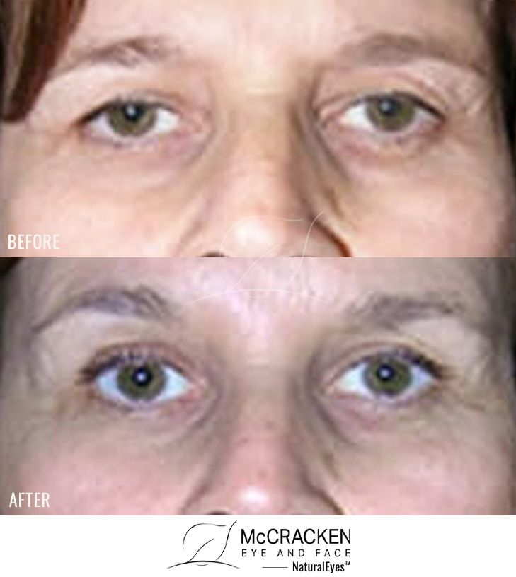 60 Year Old Female – Upper Blepharoplasty and Endoscopic Brow Lift (Forehead Lift)