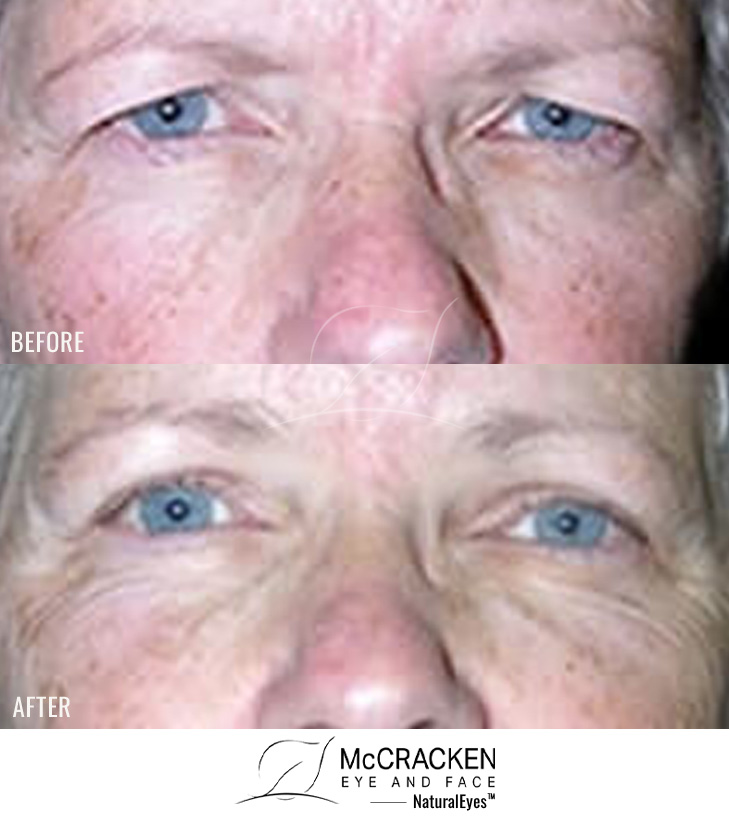 58 Year Old Female – Upper Blepharoplasty and Endoscopic Brow Lift (Forehead Lift)