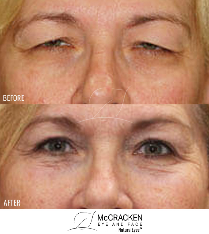50 year old female. Upper and lower blepharoplasty, Left upper lid ptosis repair, Periocular laser skin resurfacing