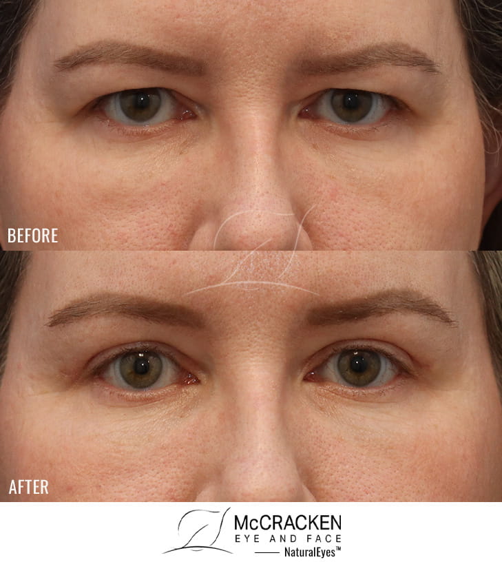 47 Year Old Female Endoscopic Brow Lift with Upper Blepharoplasty. The brow lift was fixated with EndoTines.