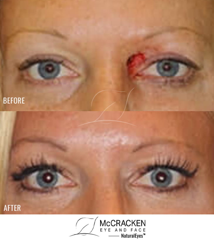 40 Year Old Female – Repair of left upper lid defect after skin cancer excision.