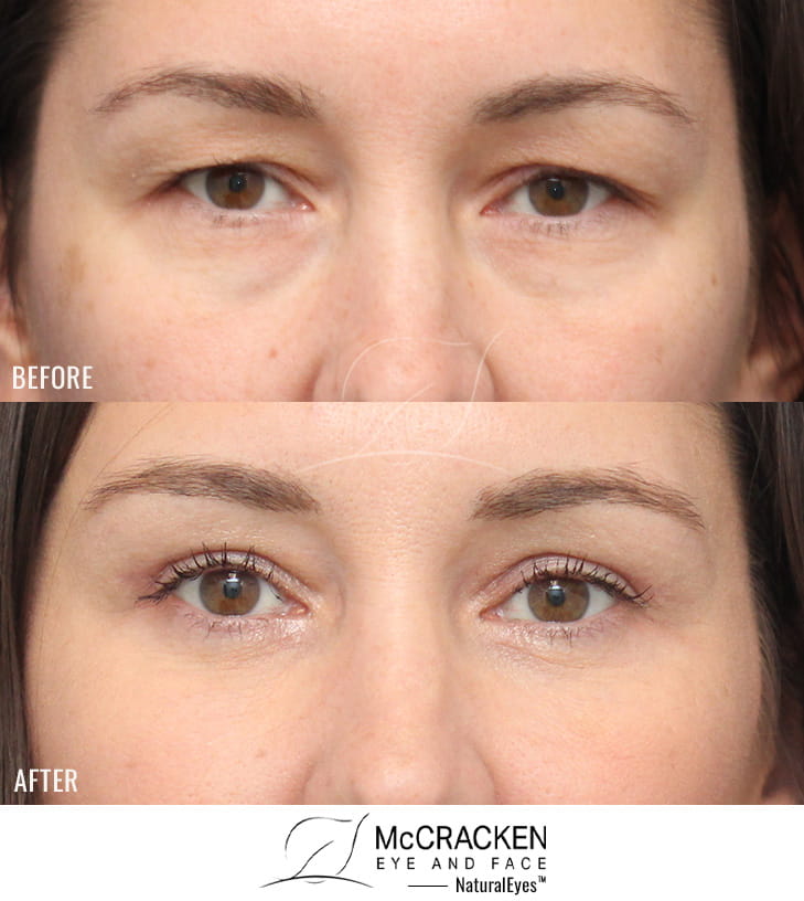 43 Year Old Female Upper and Lower Lid Blepharoplasty with Injection of 4cc of Fat to Each Cheek and Tear Trough and Laser Skin Resurfacing. No Lower Lid Skin Incisions were made, and lower lid fat was excised but not repositioned.